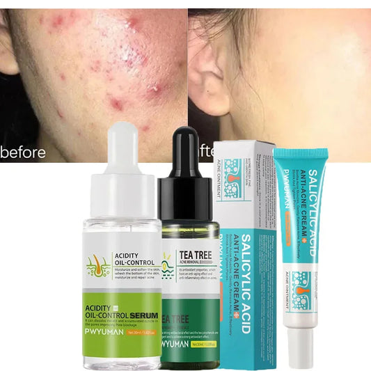 Salicylic Acid Acne Cream: Repair, Oil Control & Smooth Skin